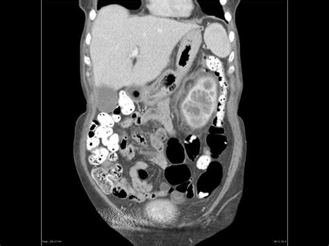 Perinephric abscess imaging