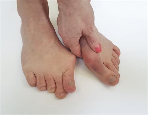 Bunion Pain and Your Treatment Options | Northwest Surgery Center