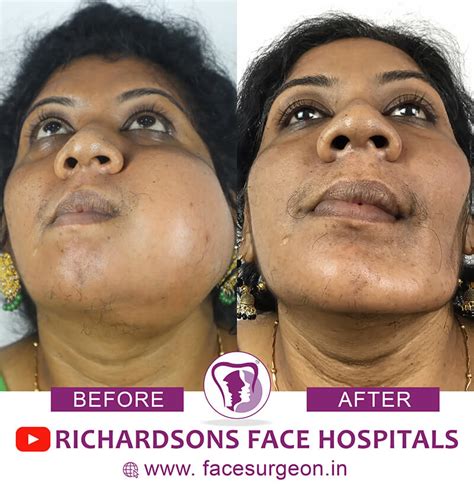 Everything You Must Know About Face Tumor Surgery – Richardson's ...