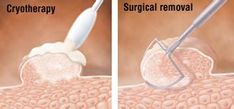 Cryotherapy and Surgical Removal of Wart - Almawi Limited The Holistic ...