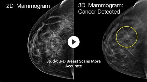 3D Scans More Accurate than Regular Mammograms