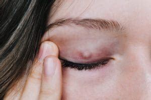 Guide to Chalazion: Symptoms, Treatment, & More | NVISION Eye Centers