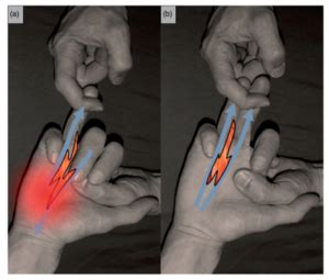 Lumbricals And Interossei Of Hand