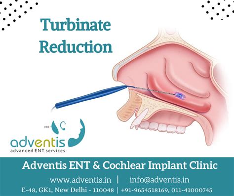 Turbinate Reduction, Nasal Turbinate Reduction Treatment & Surgery ...