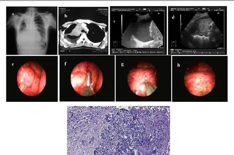 Figure 1 from Ultrasound guided closed pleural biopsy versus medical ...