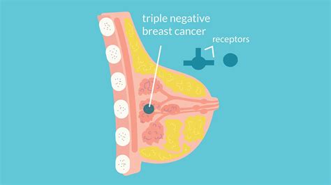 Triple negative breast cancer prognosis - taxireka