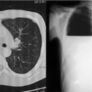 Right side hydropneumothorax. | Download Scientific Diagram