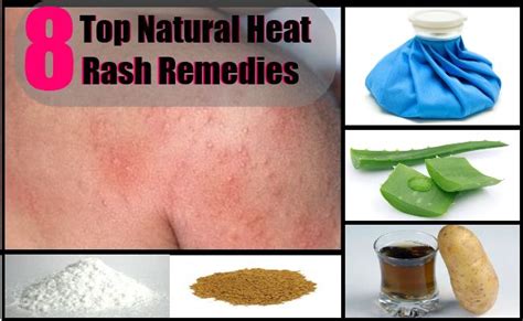 1000+ images about Heat Rash! on Pinterest | Cure Yeast Infection ...