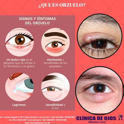 Clínica de Ojos Oftalmic Láser: QUE ES UN ORZUELO