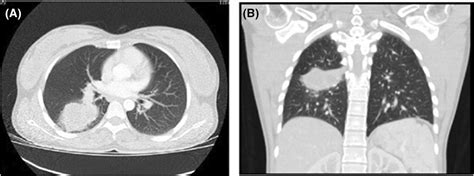 Lung abscess due to Streptococcus intermedius associated with SARS CoV ...