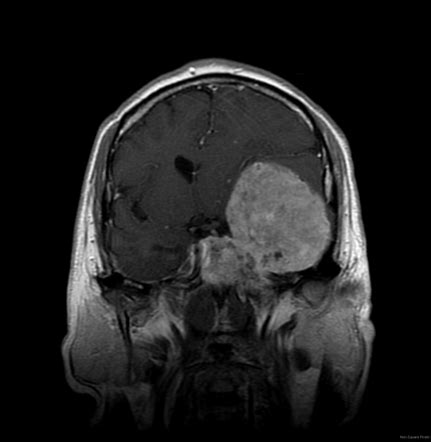 Clival masses | Radiology Reference Article | Radiopaedia.org