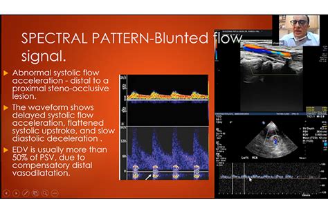 Transcranial doppler