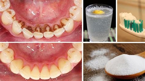 How To Remove Teeth Tartar Home Remedies