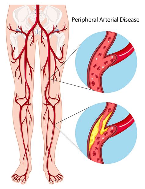 Peripheral Arterial Disease : Carolina Primary Care