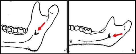 a-b: The arrow indicates the location of the mandibular foramen for an ...