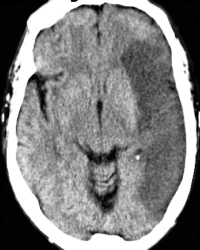 Stroke Ct Scan