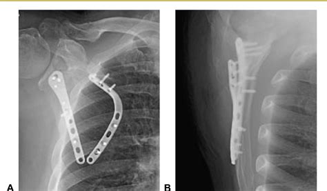 Figure From Dorsal Plate Fixation Of Scapular Fracture Free Nude | The ...