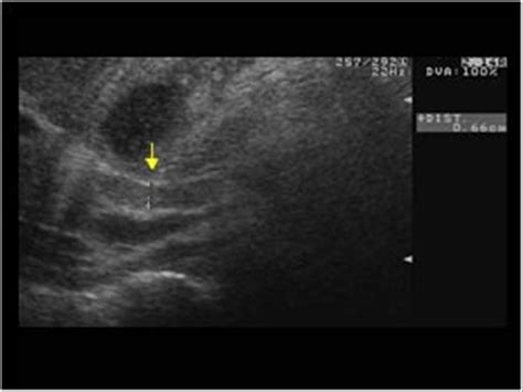 Abdomen and retroperitoneum | 1.2 Gallbladder and bile ducts : Case 1.2 ...