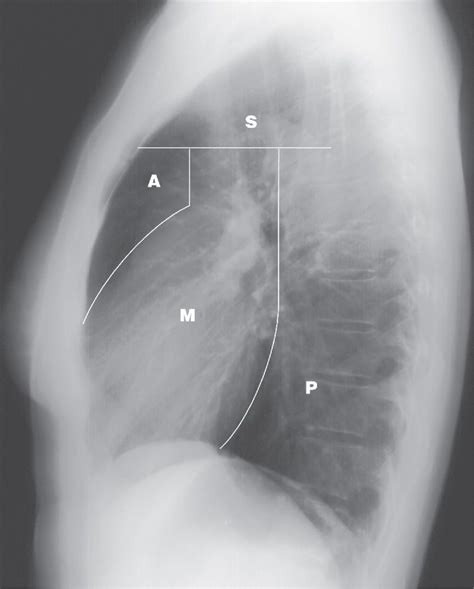 Mediastinum Chest X Ray