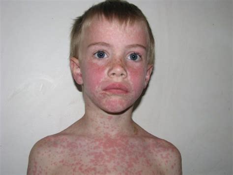 Epstein-Barr virus in children - Symptoms and Treatment