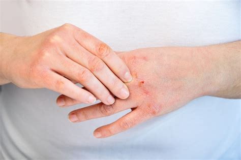 How to Avoid and Treat Dry and Chapped Hands - First Aid for Life