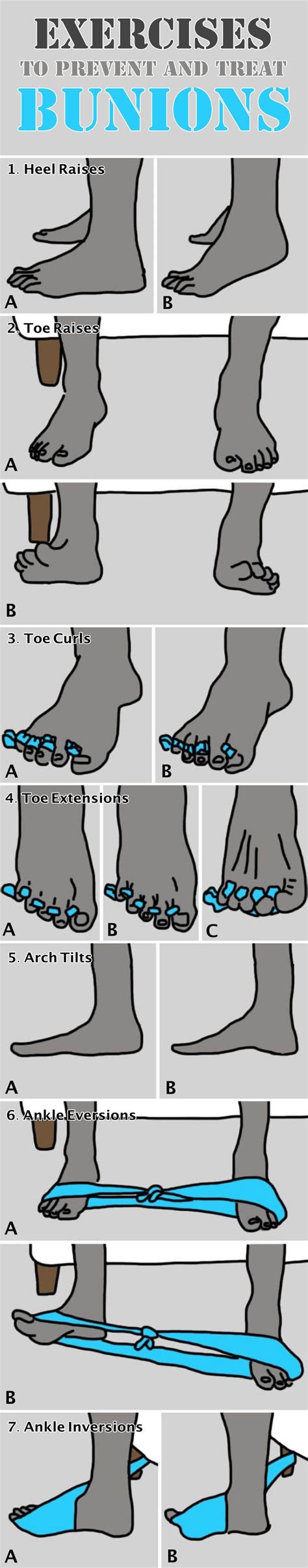 How To Prevent And Treat Bunions To Avoid Surgery - Fitneass