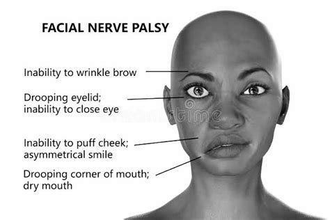 Physiotherapy for Facial Palsy. Facial Palsy is a paralysis on one side ...