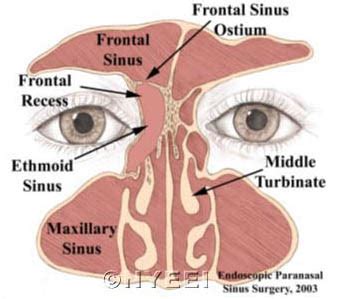 Frontal Sinusotomy - NYEE