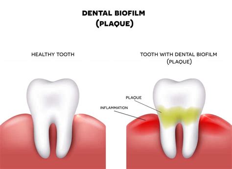 How to Remove Dental Plaque at Home - TheDentech.com