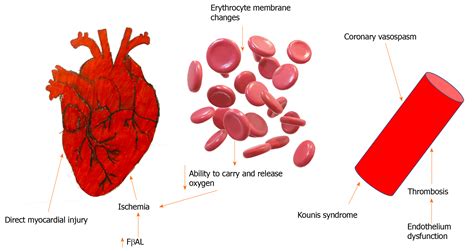 Fluoropyrimidine-induced cardiotoxicity