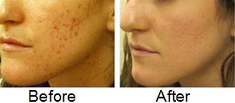 How to Fade Acne Scars Fast, Naturally, Diminish Acne Marks ...