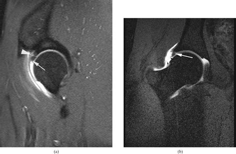 Mri Arthrogram Hip Labral Tear