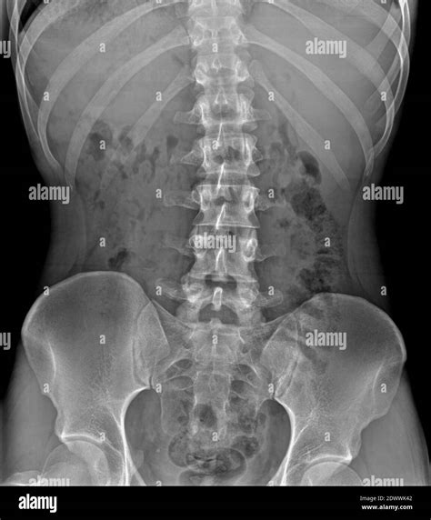 Lumbar Vertebrae Anatomy Xray