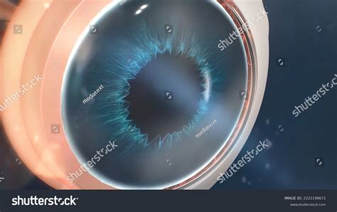 Uveitis Inflammation Part All Uvea Eye Stock Illustration 2222198671 ...