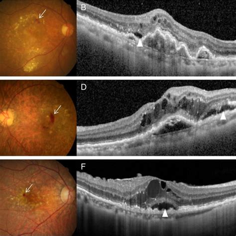 Representative images of type 3 macular neovascularization with ...