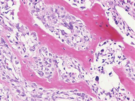 Histology Of Osteosarcoma