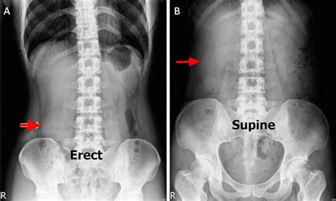 Visceroptosis AKA Glenard's Disease - A prolapse or falling or dropping ...