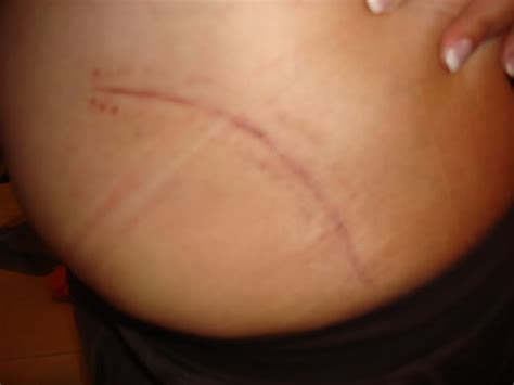 Hip Replacement Scar | Hip Replacement Scars | Pinterest | Hip ...