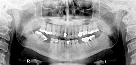 Case of the Week: Palatal Tori – Dr. G's Toothpix