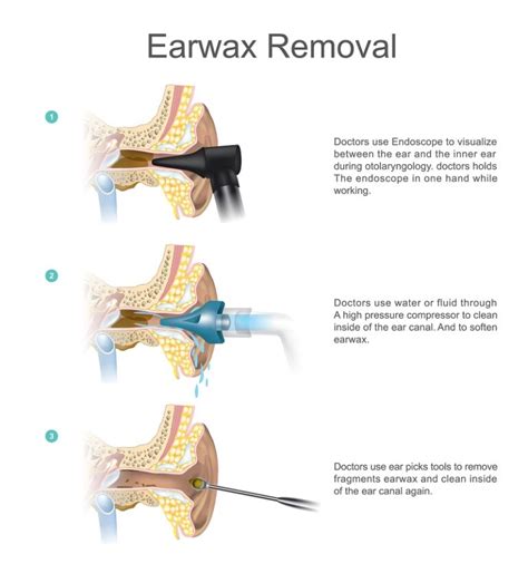 Tips To Remove Earwax - Unclogging Your Ears Safely - Heart Sense