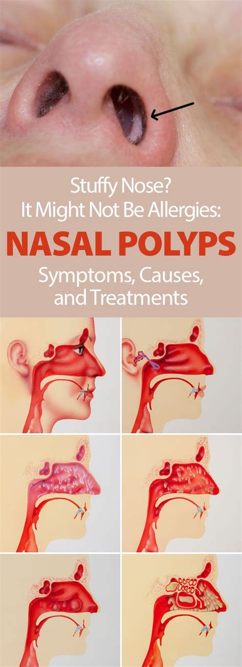 GET RID OF ALLERGIES AND NASAL POLYPS NATURALLY - Health and Wellness ...