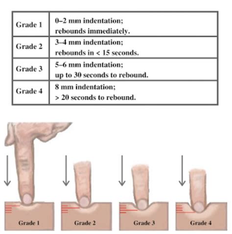 Skin: Palpation – Introduction to Health Assessment for the Nursing ...