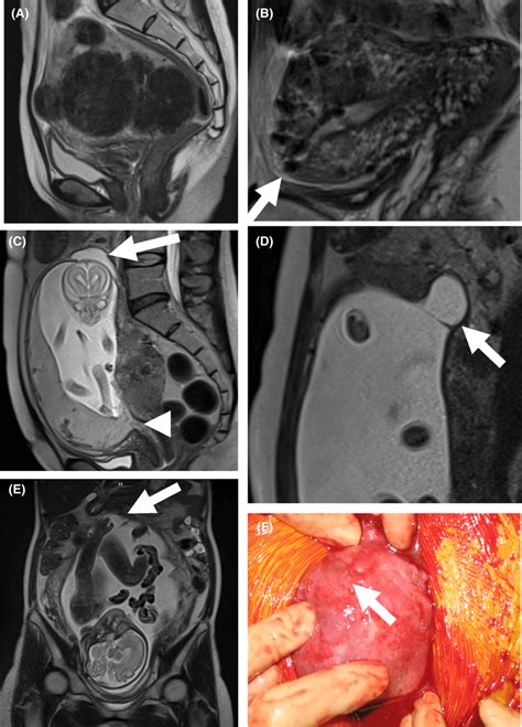 A case showing amniocele at the site of scar defect in pregnancy after ...