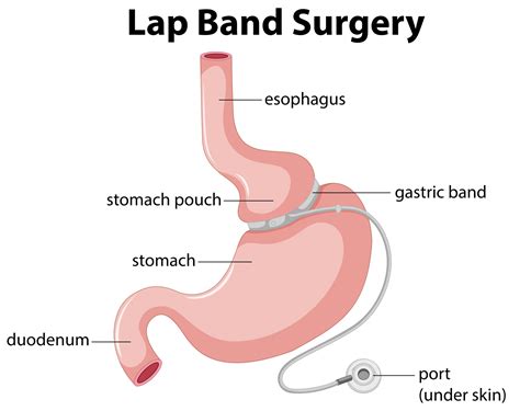 Gastric lap band | Centre for Bariatric Solutions