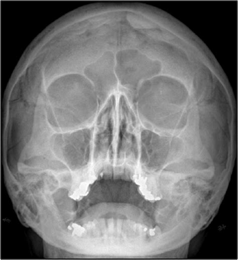 Sinus X-ray examination showed bilateral acute frontal sinusitis ...