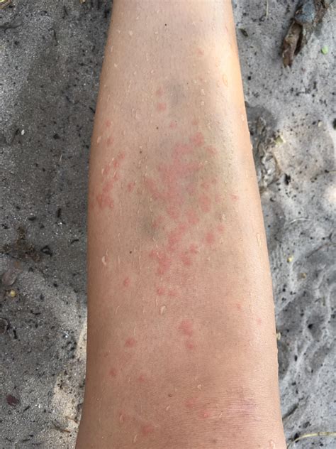 Itchy red bumps after swimming in the ocean. Think it was caused by a ...