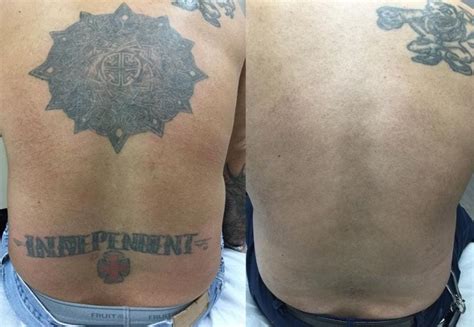 Laser Tattoo Removal Before and After | Removery