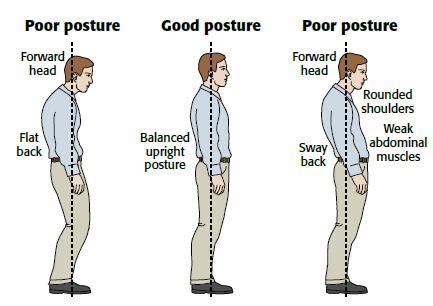 Symptoms, Causes and Treatment of Bad Posture