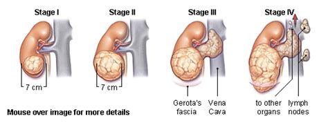 Renal Cancer - Physiopedia