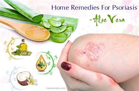 25 Home Remedies For Psoriasis On Face, Hands, Legs And Scalp